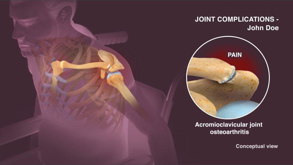 Shoulder Joint Instability Artery Studios HealthCare Visuals