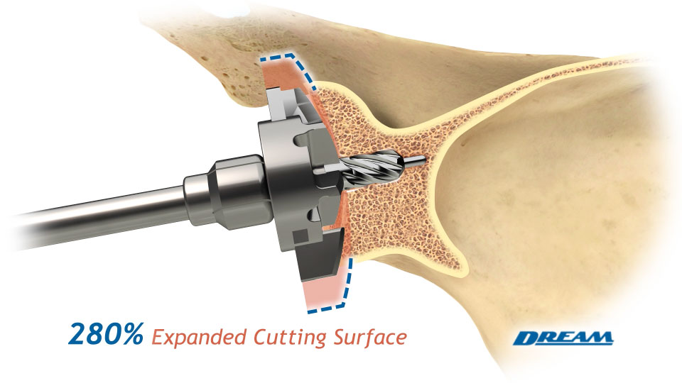 DreamReam™ Expandable Profile Reamer Artery Studios HealthCare Visuals