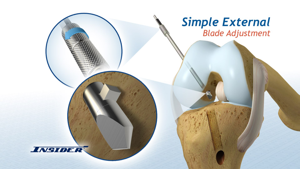 ACL Insider™ Expandable Reamer Artery Studios HealthCare Visuals